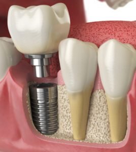 Anatomy of healthy teeth and tooth dental implant in human dentu